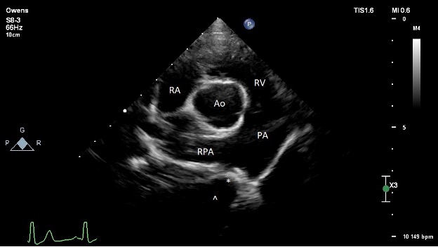 Image of Figure 4: Post-operative transthoracic echocardiography image obtained from the right parasternal short axis at the level of the heart base. The ACDO device is observed in the PDA, denoted with an asterisk (*). The ampulla of the ductus is denoted with a caret (^). RA = right atrium; RV = right ventricle; PA = main pulmonary artery; RPA = right pulmonary artery; Ao = aorta.