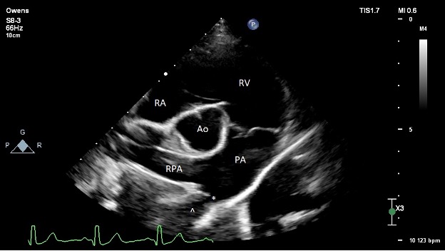 Image of Figure 2: Pre-operative transthoracic echocardiography image obtained from the right parasternal short axis at the level of the heart base. The ostium of the PDA is denoted with an asterisk (*). The ampulla of the ductus is denoted with a caret (^). RA = right atrium; RV = right ventricle; PA = main pulmonary artery; RPA = right pulmonary artery; Ao = aorta.